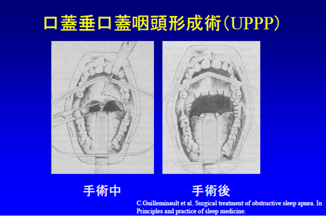 定義拡散勃起
