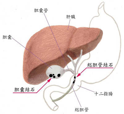 胆石症