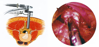 MED(内視鏡下椎間板摘出術)とは